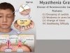 5 Natural Remedies For Myasthenia Gravis Easy Way To Change Your Lifestyle