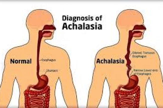 How To Get Rid Of Achalasia At Home With Nutrients And Essential Oils