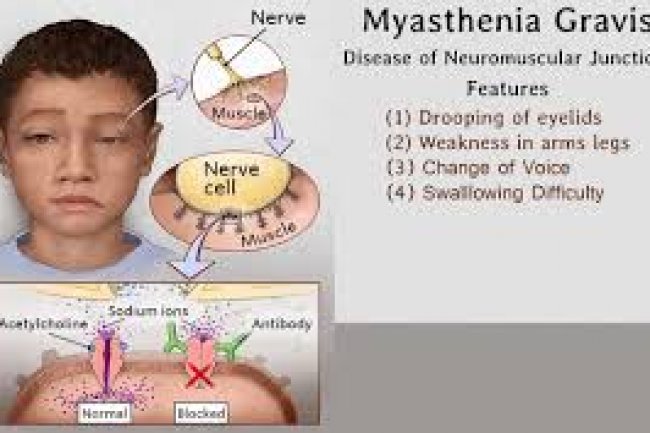 5 Natural Remedies For Myasthenia Gravis Easy Way To Change Your Lifestyle