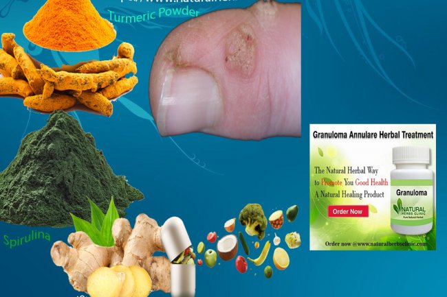 How Might Granuloma Annulare Be Treated With Home Remedies