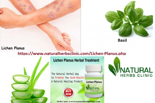Make Use Of Natural Remedies For Lichen Planus Scars