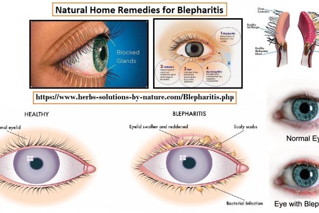 Natural Remedies for Blepharitis Treat with Natural Essential Oils