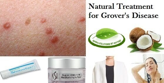 7 Natural Remedies For Grover?s Disease Treat With Neem Leaves