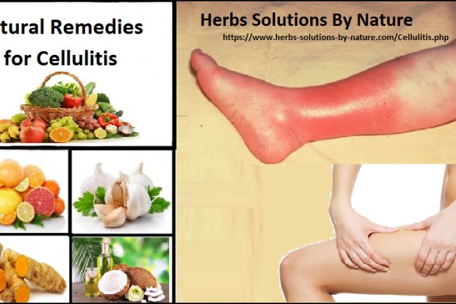 Natural Remedies for Cellulitis Treat with Natural Essential Oils