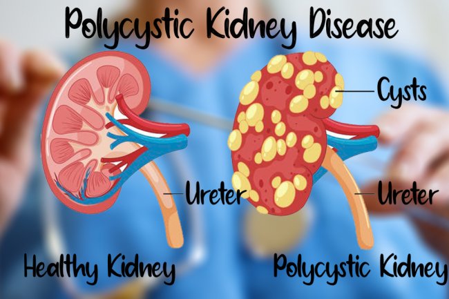 Natural Remedies for Polycystic Kidney Disease and Healthy Diet