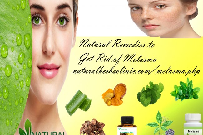 7 Natural Remedies to Get Rid of Melasma