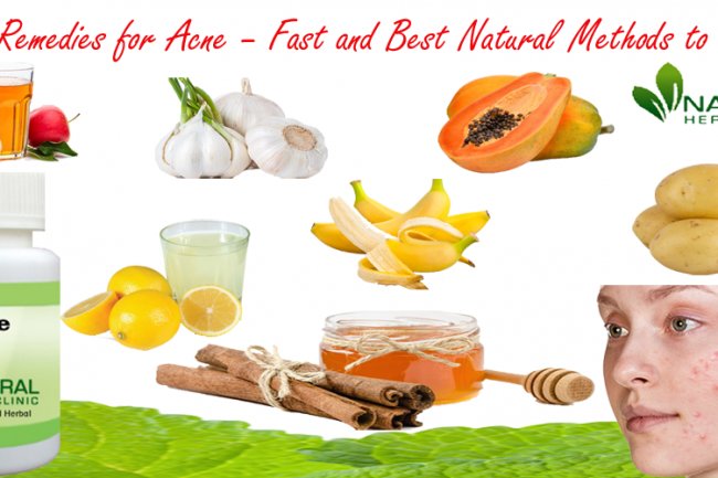 Natural Remedies for Acne – Fast and Best Natural Methods to Get Rid of it