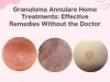 Granuloma Annulare Home Treatments: Effective Remedies Without the Doctor
