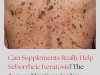 Can Supplements Really Help Seborrheic Keratosis? The Answer May Surprise You