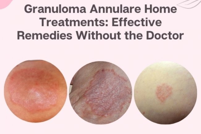 Granuloma Annulare Home Treatments: Effective Remedies Without the Doctor