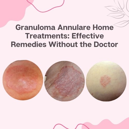 Granuloma Annulare Home Treatments: Effective Remedies Without the Doctor