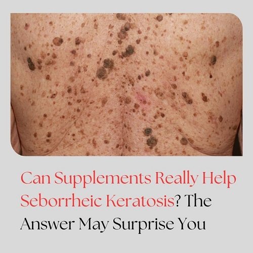 Can Supplements Really Help Seborrheic Keratosis? The Answer May Surprise You
