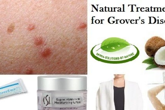 7 Natural Remedies For Grover?s Disease Treat With Neem Leaves