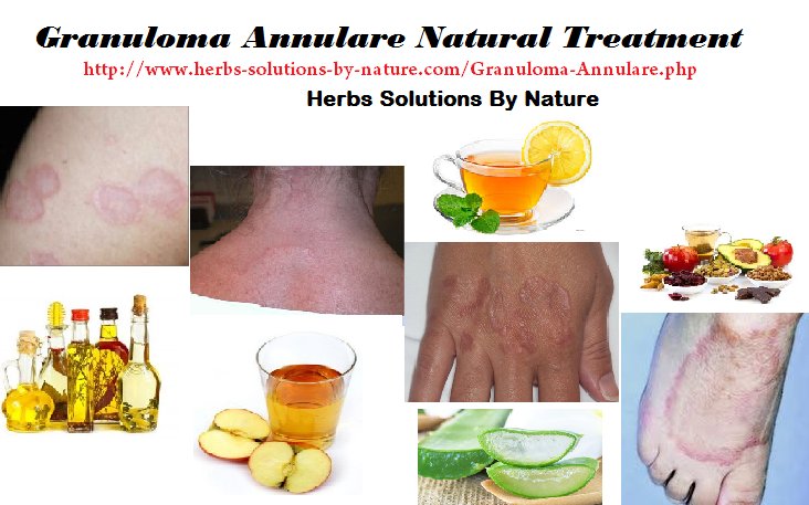 7 Effective Natural Treatments for Granuloma Annulare 
