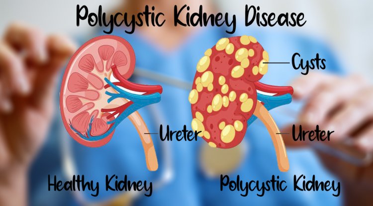 Natural Remedies for Polycystic Kidney Disease and Healthy Diet - Dubai ...