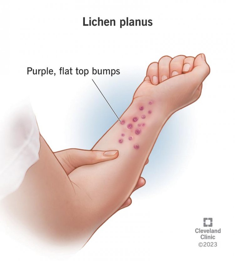 Top 10 Herbal Treatments for Lichen Planus You Need to Try!